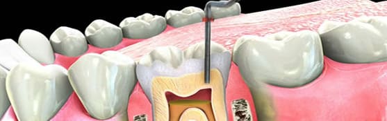 Root Canal Specialist in Gurgaon