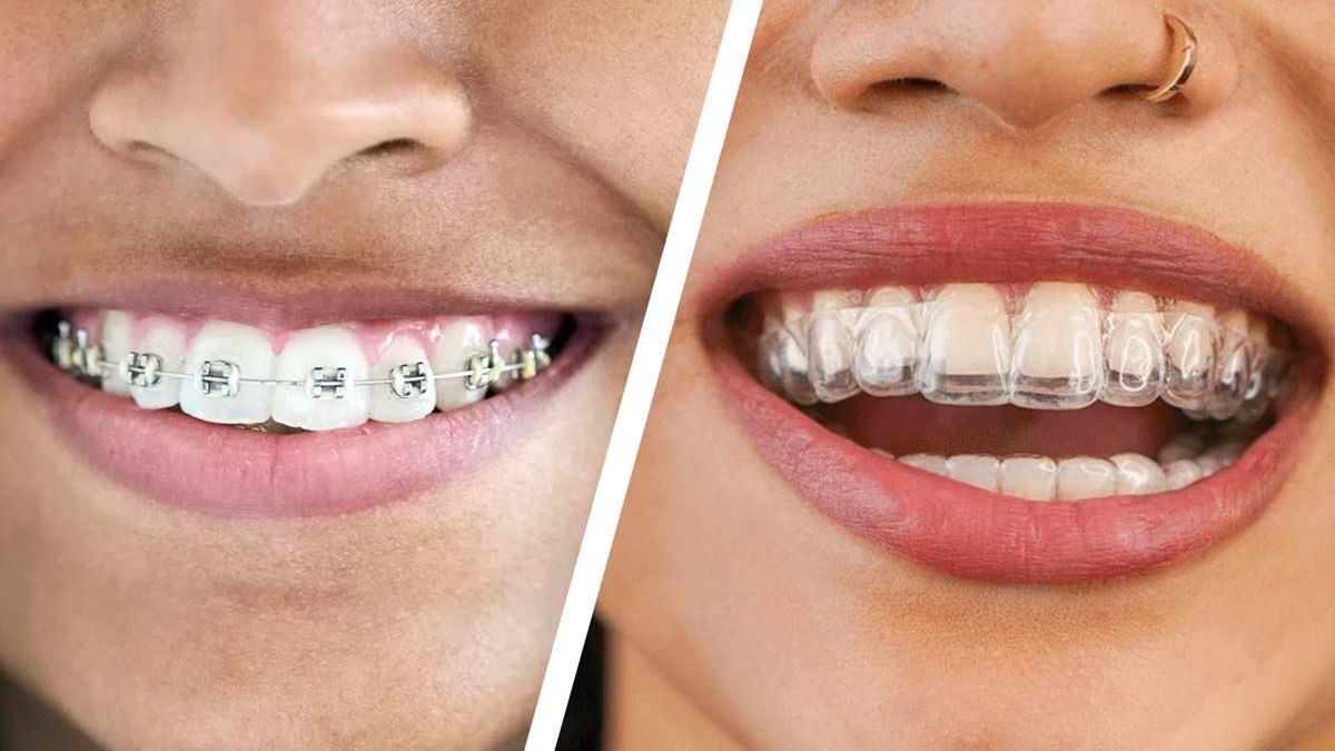 Braces vs. Aligners: Which One Is Right for You?