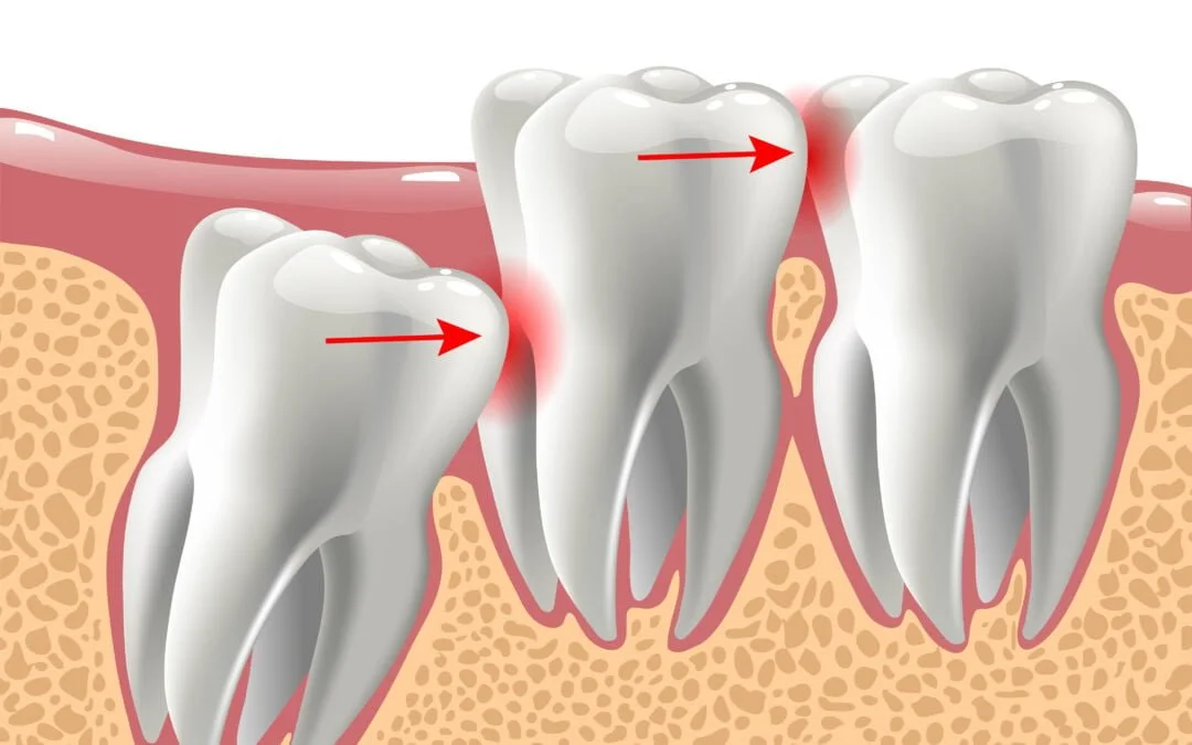 Wisdom Tooth Removal in Gurugram: When to See an Oral Surgeon