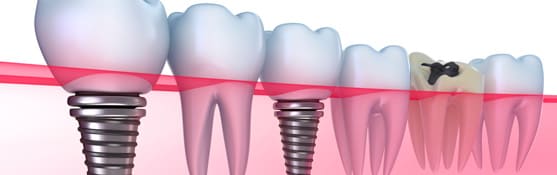 Dental Implants