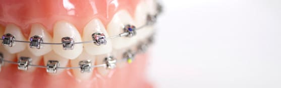 Braces Specialist in Gurgaon